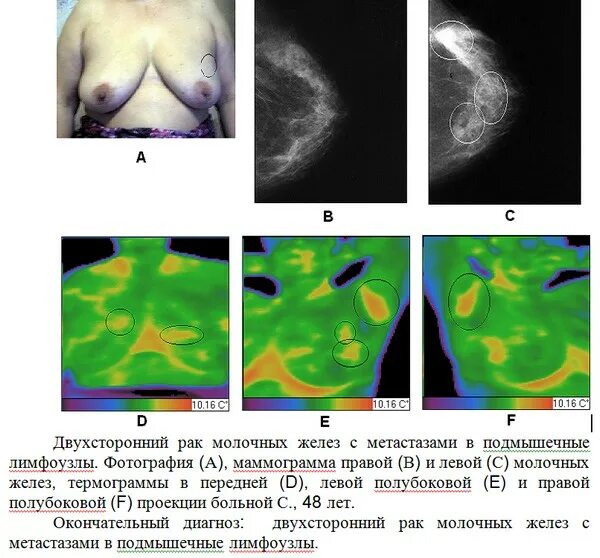 Рак груди 4 стадия фото распад опухоли Термографическая диагностика заболеваний молочных желез.Продолжение. Здравия жел