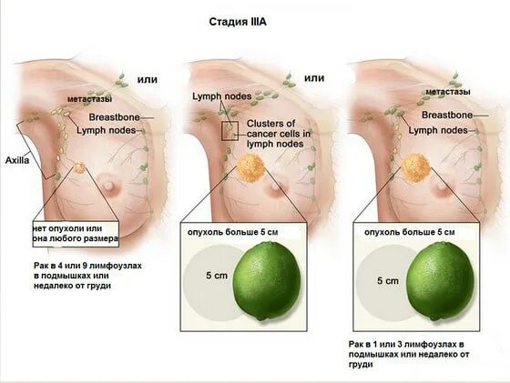 Рак груди фото начальная стадия как выглядит Лечение рака молочной железы 3 стадии в Израиле в клинике Ассута