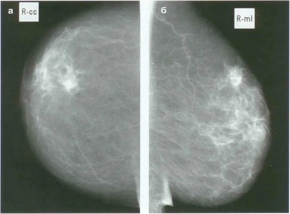 Рак груди фото начальная стадия как выглядит Узловая форма рака молочной железы