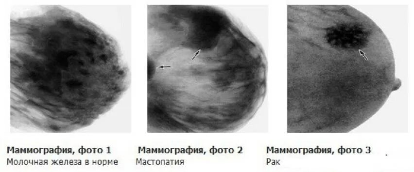 Рак груди первой стадии фото Рентгенологическая картина фиброзно кистозной мастопатии