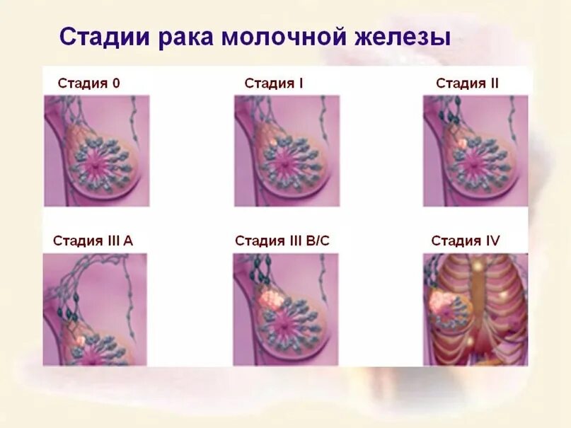 Рак груди первой стадии фото 2 стадия молочной железы - найдено 84 картинок