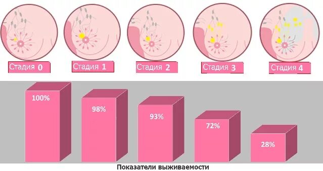 Рак груди первой стадии фото Лечение рака груди в Германии: маммология, онкология молочной железы, цены, отзы