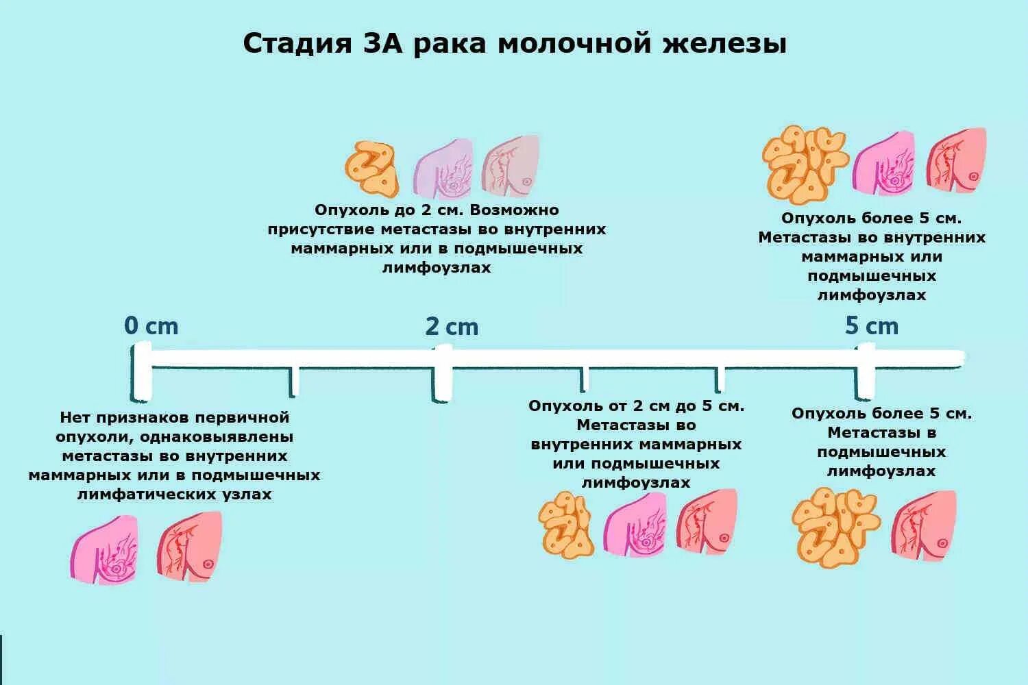 Рак груди симптомы признаки фото Стадии рака груди у женщин