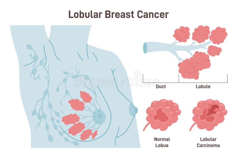 Рак груди симптомы у женщин фото Ductal Carcinoma. Detailed Breast Medical Anatomy with Lactiferous Stock Vector 