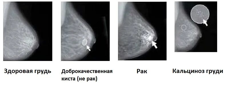 Рак груди1 симптомы фото Рентген молочных желез: показывает ли маммография рак, затемнения на снимке afro