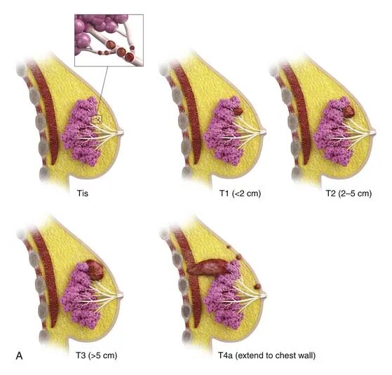 Рак груди1 симптомы стадии фото Breast Cancer Clinical Gate