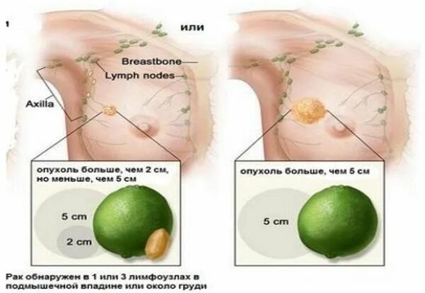 Рак груди1 симптомы стадии фото Рак молочной железы 2 степени: продолжительность жизни, лечение