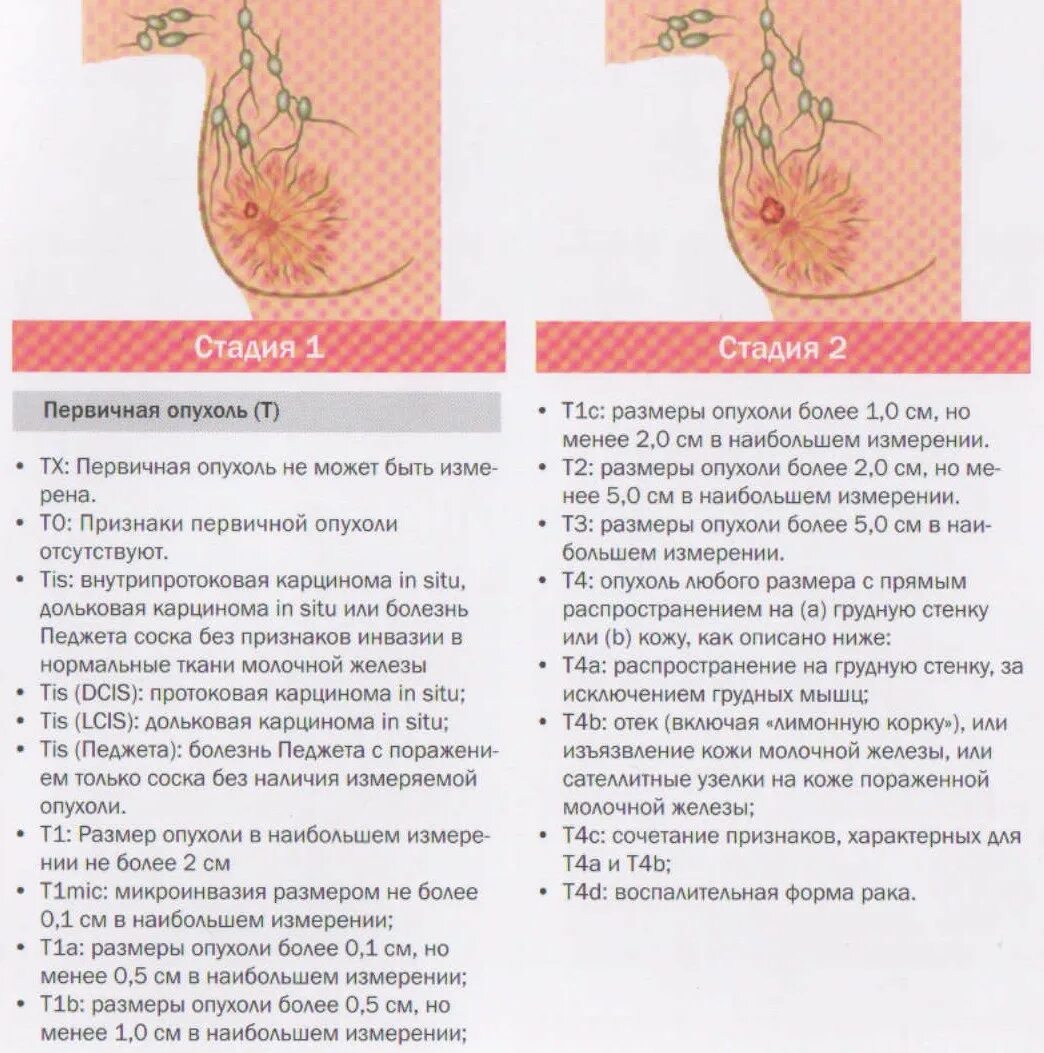Рак груди1 стадии фото Первые стадии рака молочной железы: начало опухолевого роста