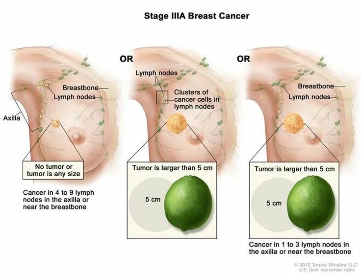 Рак груди1 стадии фото Pin on Breast cancer