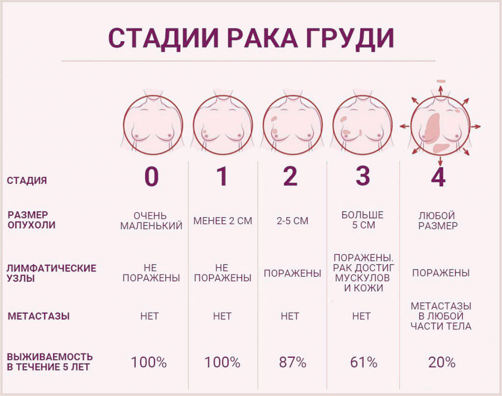 Рак груди1 стадии фото Лечение рака молочной железы - Бушуев Семен Дмитриевич