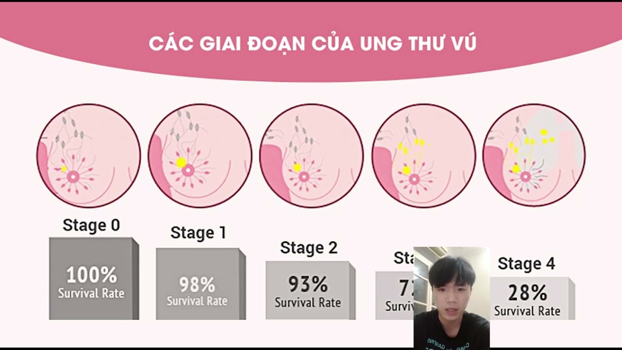 Рак груди1 стадии фото у женщин Tài chính tiêu dùng - YouTube