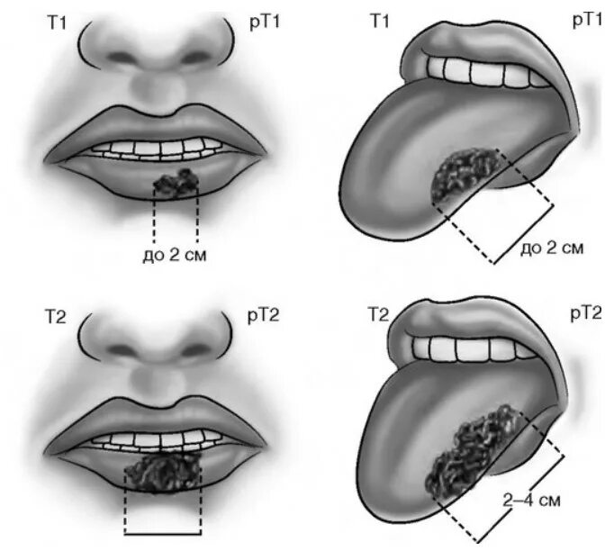 Рак губы 1 стадия фото Причины и факторы риска онкологии рта - злокачественные опухоли полости рта Нова