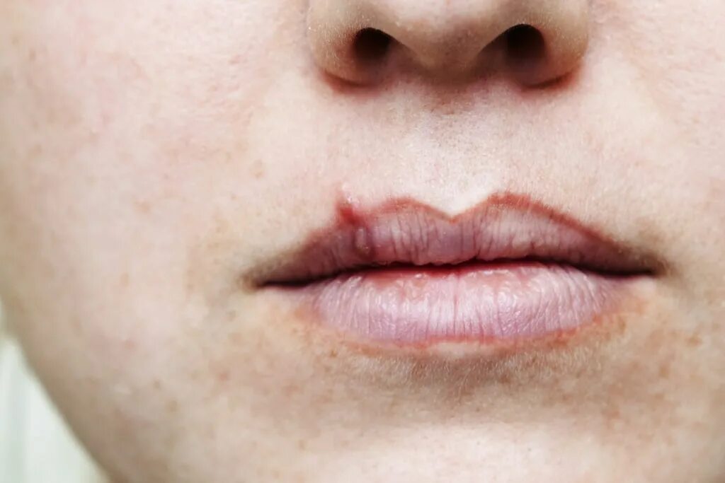 Рак губы начальная стадия фото как выглядит Half of Americans have cold sore virus; 12 percent genital herpes