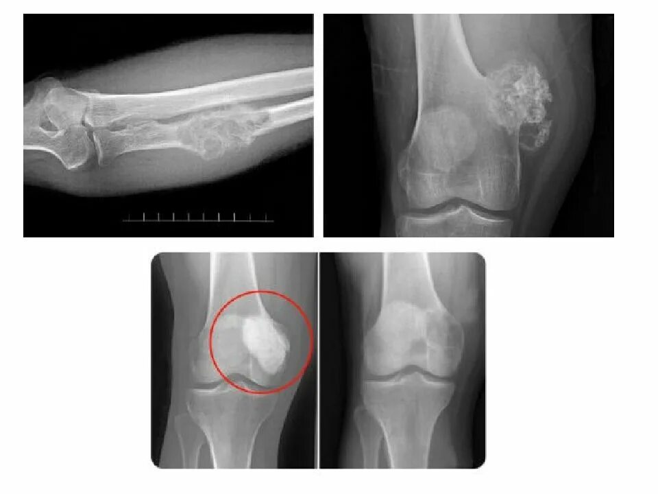 Рак коленного сустава симптомы фото Опухоли костной ткани Опухоли костной ткани Подготовила презентацию с тудентка