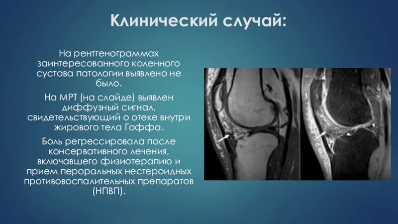 Рак коленного сустава симптомы фото Онкология колена: найдено 89 изображений