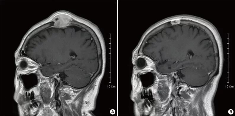 Рак костей черепа фото человека Magnetic resonance imaging (MRI) image of larger and smaller mass. (A)... Downlo