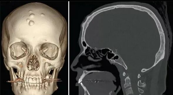 Рак костей черепа фото человека Показывает ли КТ онкологию - признаки онкологического процесса на снимках КТ