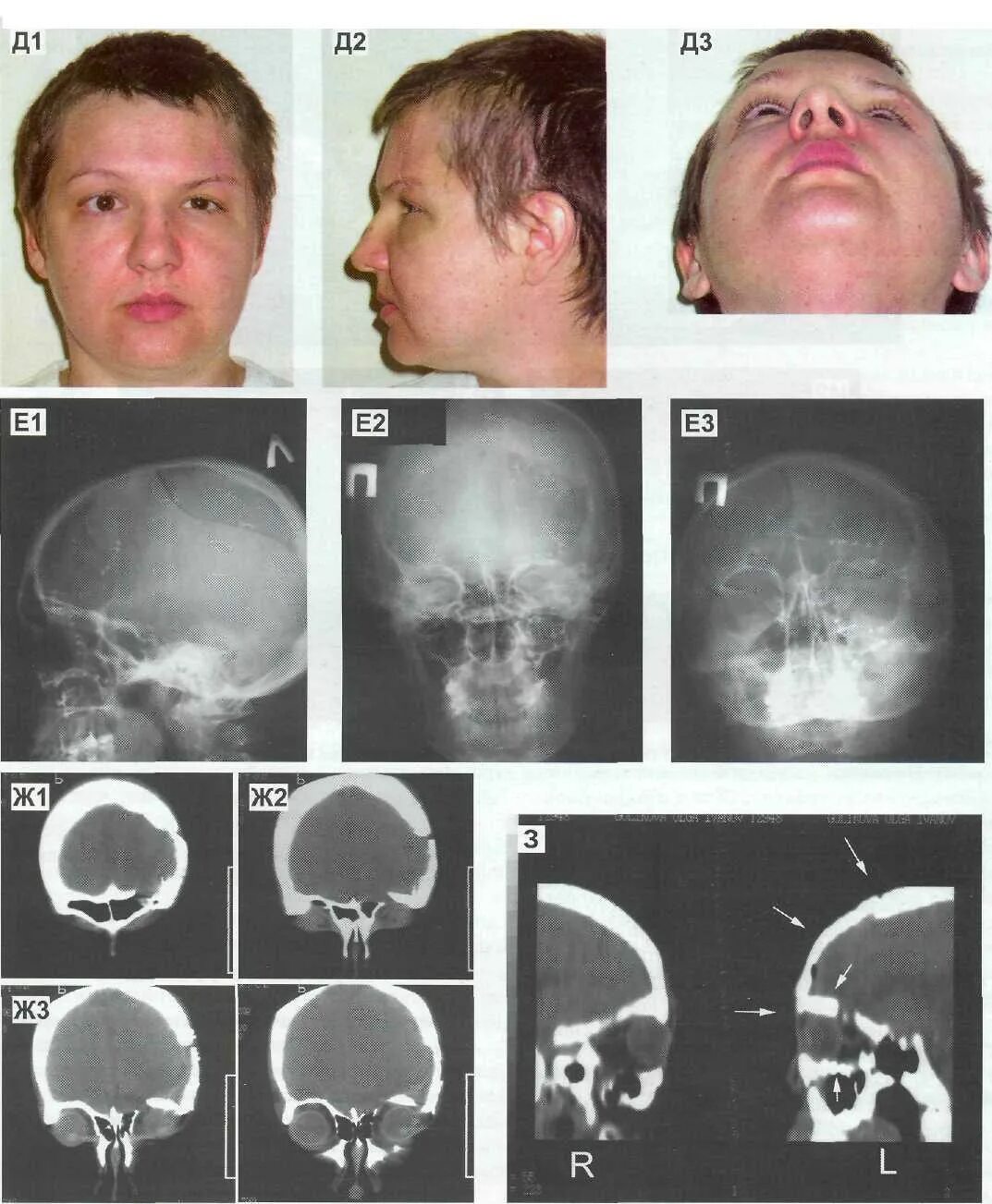 Рак костей черепа фото человека 16.5.3.2. Повреждение нижней стенки орбиты