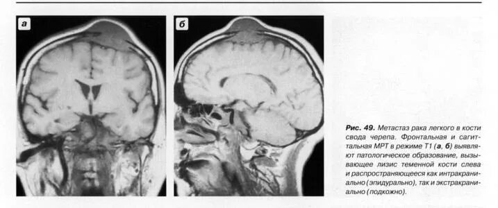 Рак костей черепа фото человека Поражение костей свода черепа Портал радиологов