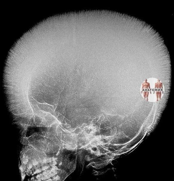 Рак костей черепа симптомы фото The phenomenon of "hairy skull" or needle periostosis in thalassemia 2022 Анатом