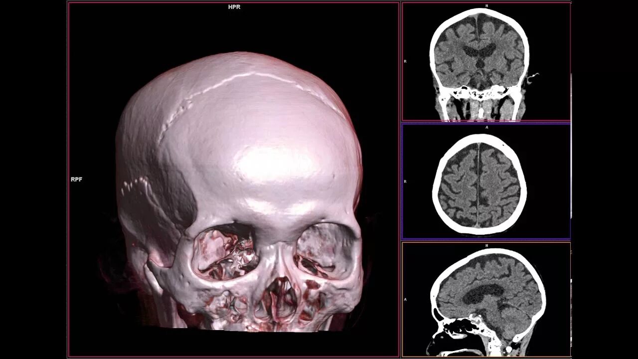 Рак костей черепа симптомы фото HEAD CT SCAN 3D BONE - YouTube