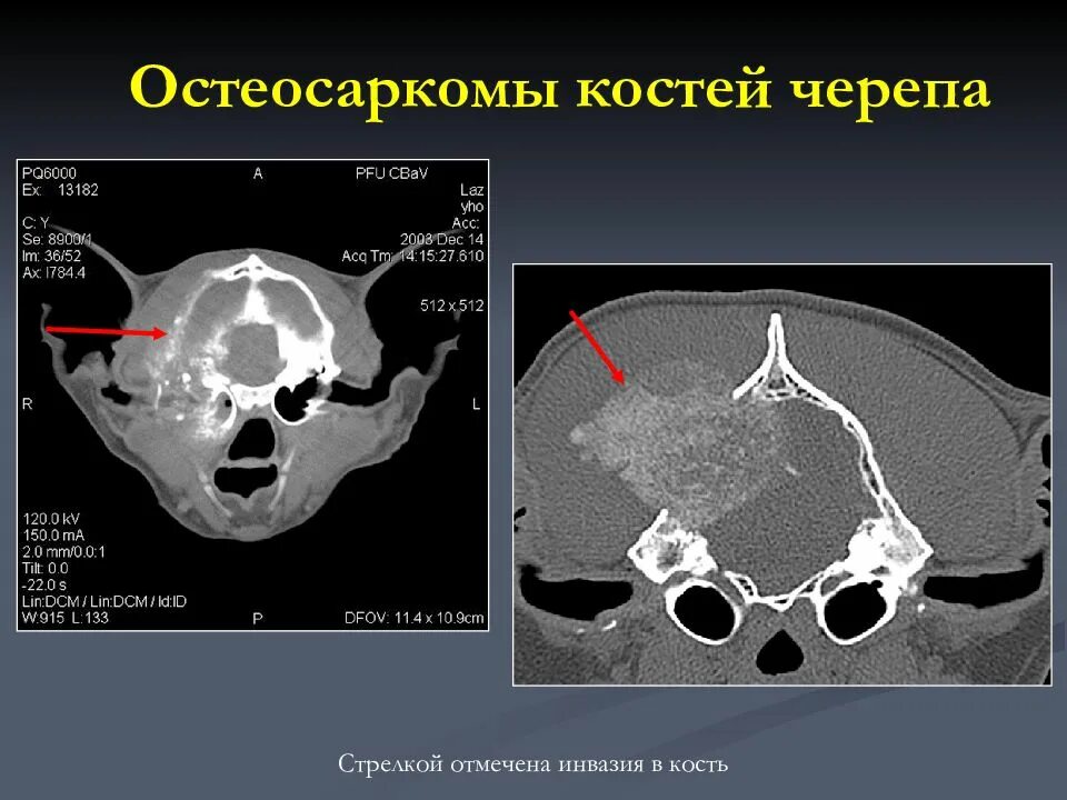 Рак костей черепа симптомы фото Кт скелета