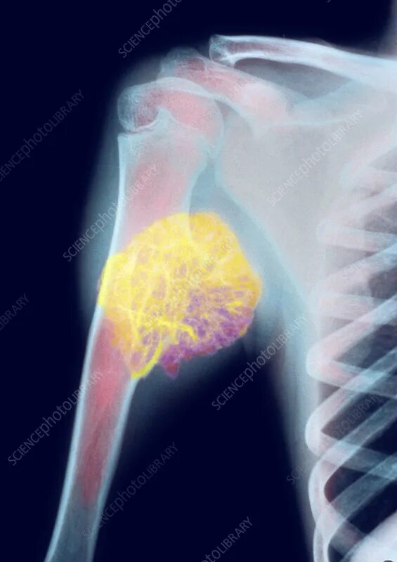 Рак костей фото больных Bone tumour, X-ray - Stock Image - M134/0445 - Science Photo Library