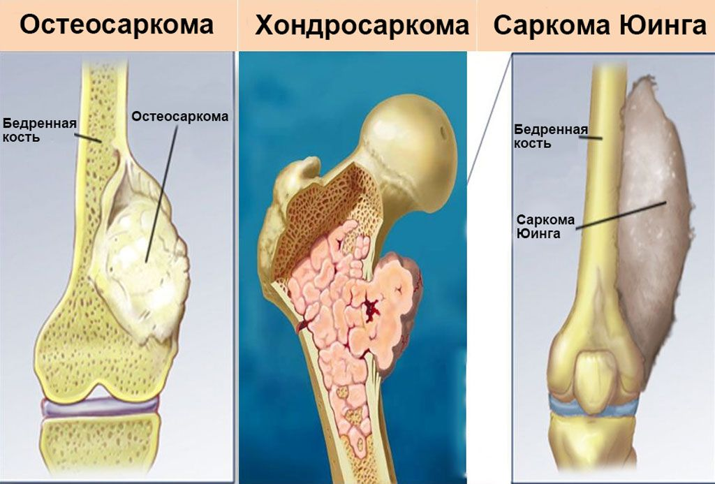 Рак костей фото больных Редкий, но опасный вид рака: что такое саркома и где она может возникать О здоро