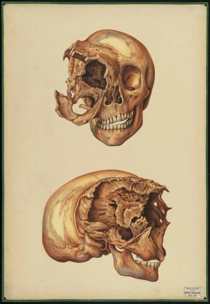 Рак костей фото черепа Teaching watercolor of skull deformed near the right eye socket Deformity art, S