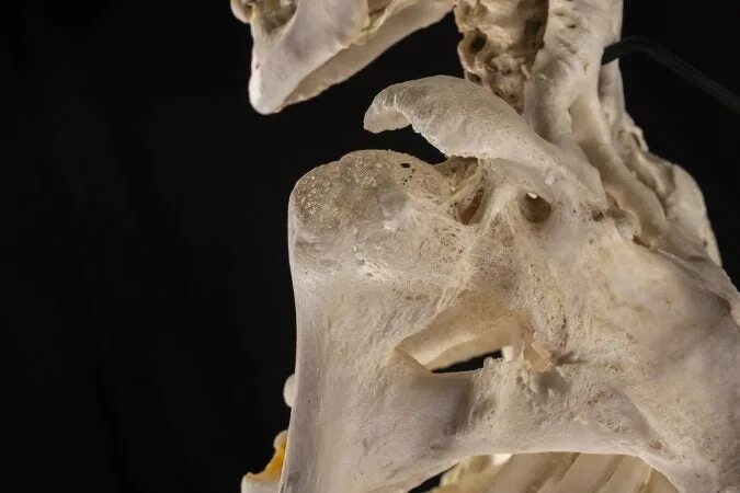 Рак костей фото скелета Mütter Museum displays Philly woman's 'fully fused' skeleton - WHYY