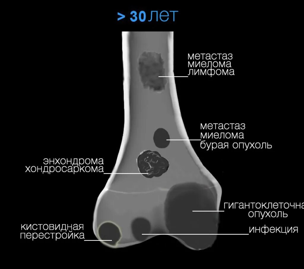 Рак костей признаки фото Опухоли костей (системный подход и дифференциальная диагностика)