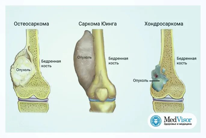 Рак костей признаки фото Рак костей симптомы у женщин первые признаки и симптомы - Арт Минск.ру