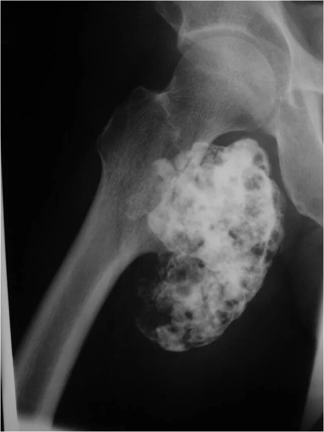 Рак кости фото начальная стадия Osteochondroma : Benign Bone Tumor: Tumors of the bone