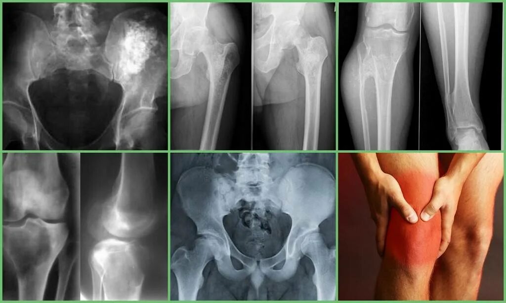 Рак кости фото начальная стадия Рак кости сустава: найдено 85 изображений