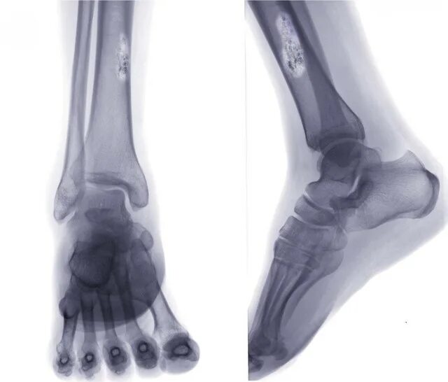 Рак кости ноги симптомы фото Рак костей. Онкология