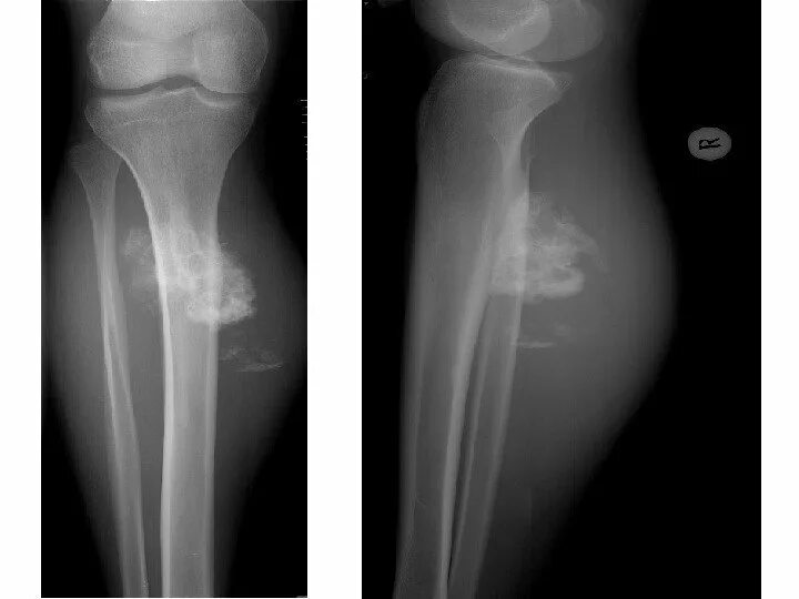 Рак кости ноги симптомы фото Рак кости ноги