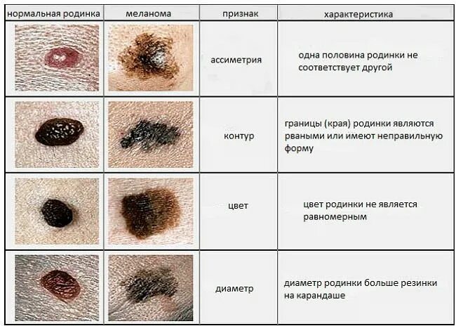 Рак кожи фото как выглядит Как вовремя распознать меланому?