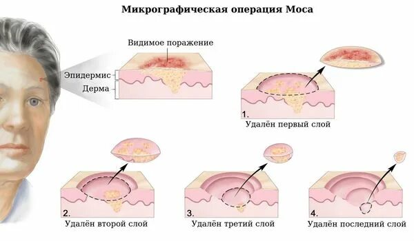 Рак кожи лица фото стадий Базалиома (базальноклеточный рак): причины, симптомы и лечение в статье онколога