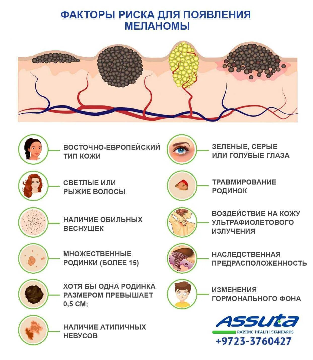 Доброкачественные и злокачественные невусы: тревожные признаки больших родинок -