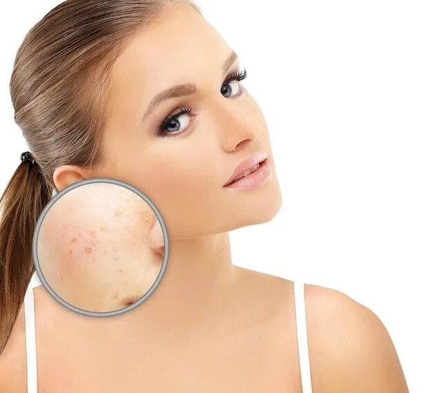 Рак кожи лица симптомы фото Premium Photo Post Acne Marks Treating Acne Scars