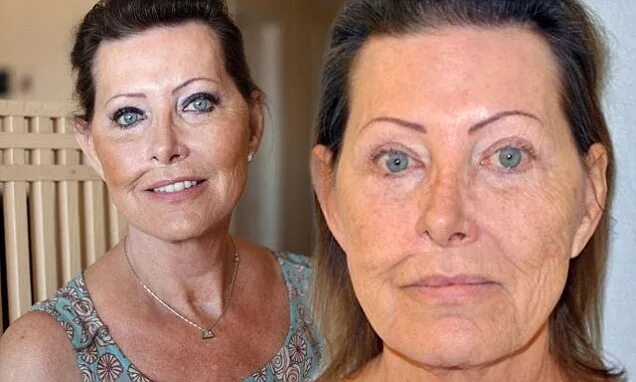 Рак кожи на лице фото My face was wrecked by skin cancer... but my plastic surgeon left me looking 10 