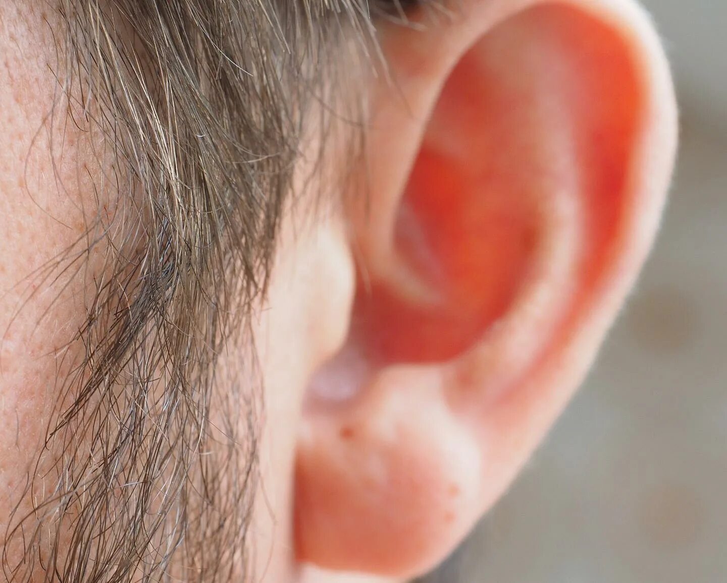 Рак кожи на ухе фото Sound deprivation in one ear leads to speech recognition difficulties