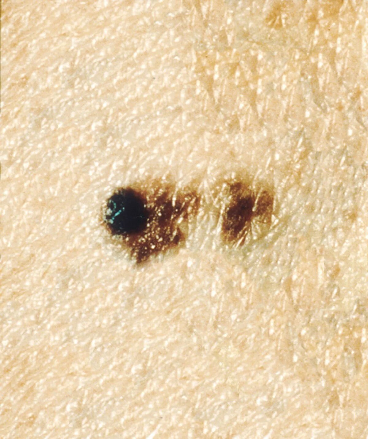 Рак кожи начальная стадия фото меланома Súbor:Melanoma (3).jpg - Wikipédia