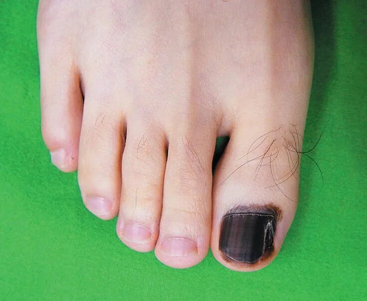 Рак кожи ноги как выглядит фото Hutchinson's Nail Sign - NEJM Nail signs, Black nails, Toe nails