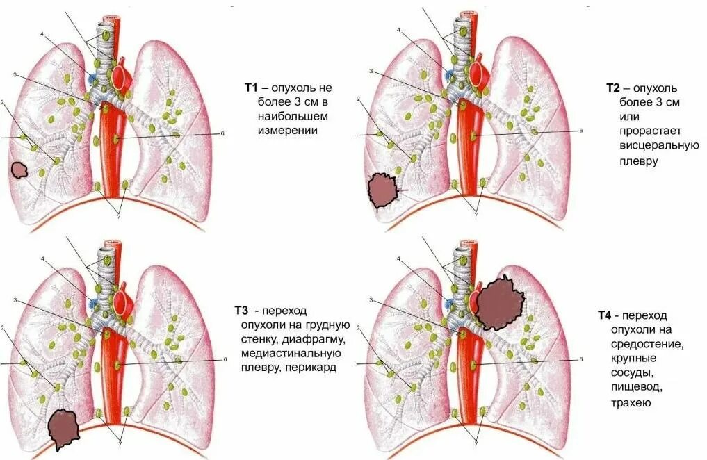 Рак легких 4 стадия фото Лечение рака лёгких в Москве - симптомы, диагностика, стадии, прогноз
