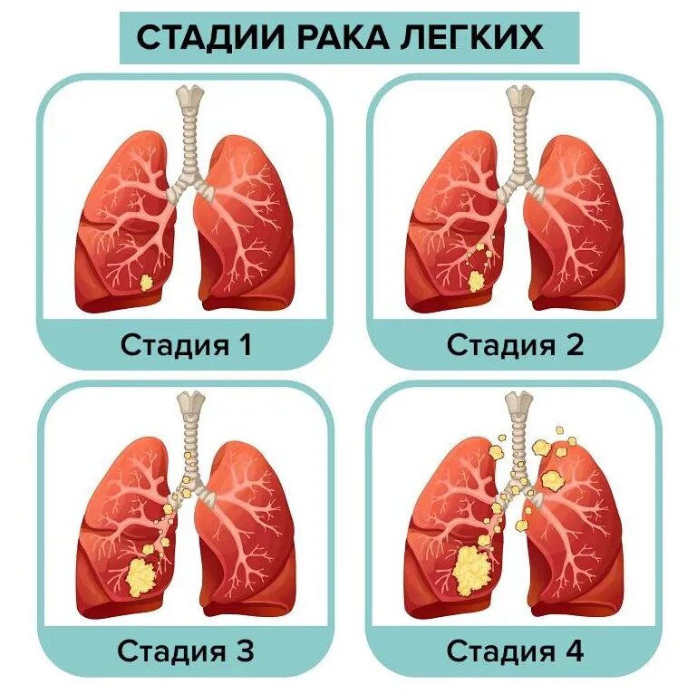 Рак легких 4 стадия фото Вся правда о РАКЕ ЛЕГКИХ - причины, симптомы, виды, стадии опухолей легкого Medn