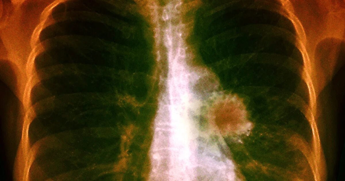 Рак легких 4 стадия фото Scientists Intrigued by Pill That Cuts Lung Cancer Deaths in Half