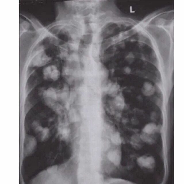 Рак легких 4 стадия фото Mosaiced on Instagram: "what's the cause of cannonball mets? #medstudent #foamed