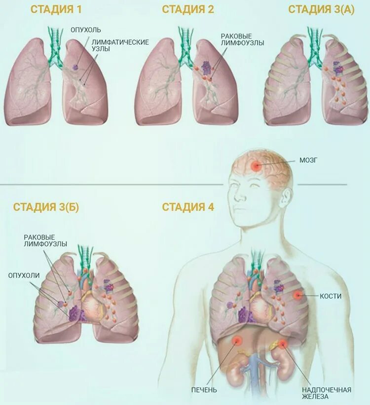 Рак легких 4 стадия фото Картинки ОПУХОЛЬ ЛЕГКИХ ЛЕВОГО