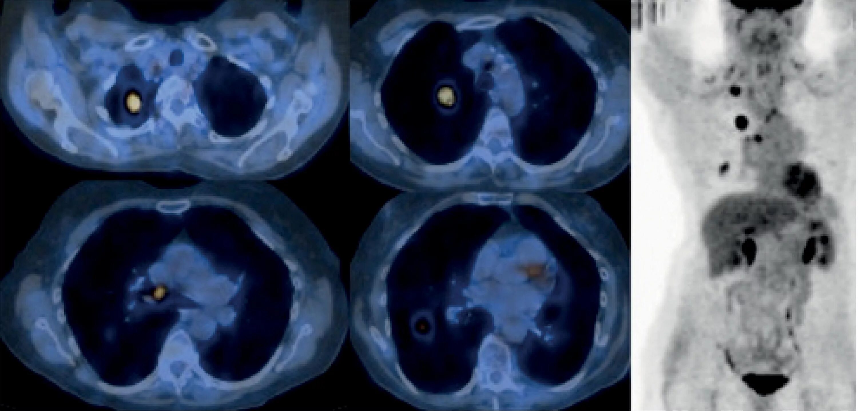 Рак легких 4 стадия фото SciELO - Brasil - PET/CT imaging in lung cancer: indications and findings PET/CT